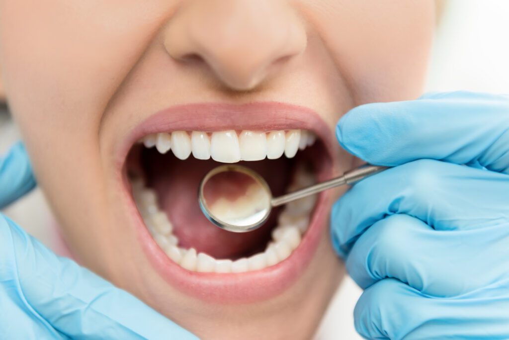 Tooth Filling Summit NJ